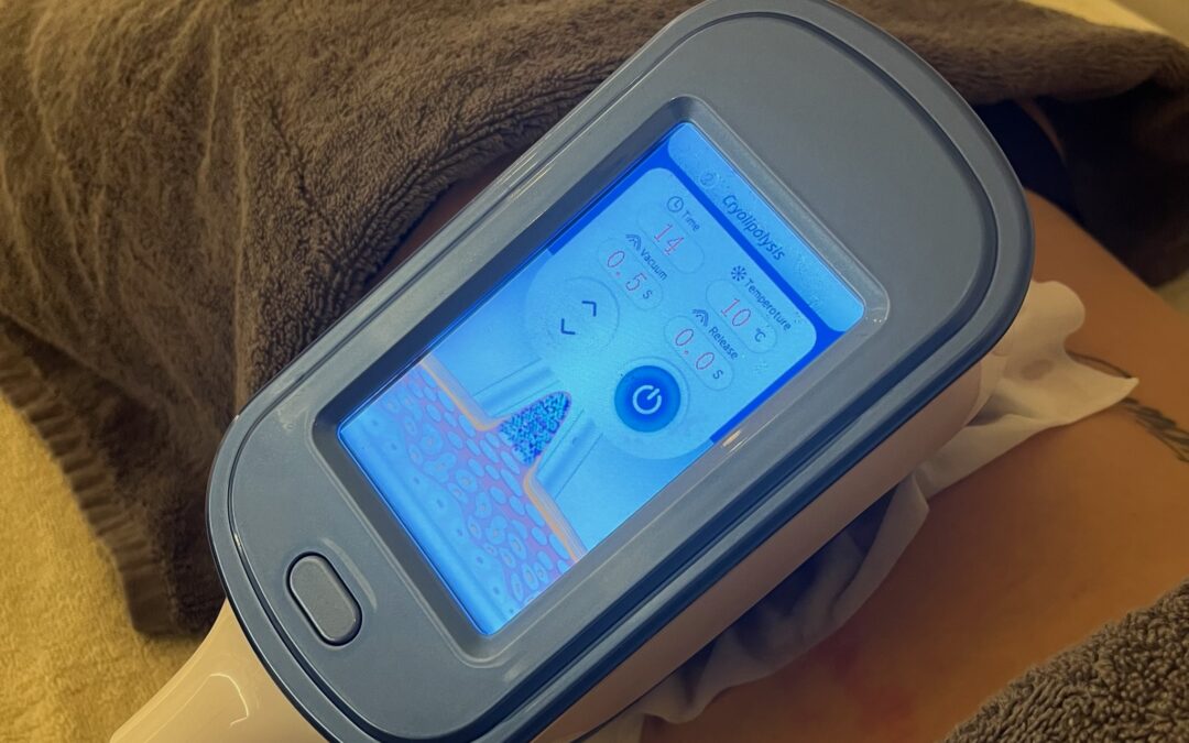 Who should not have cryolipolysis, and the side effects worth knowing