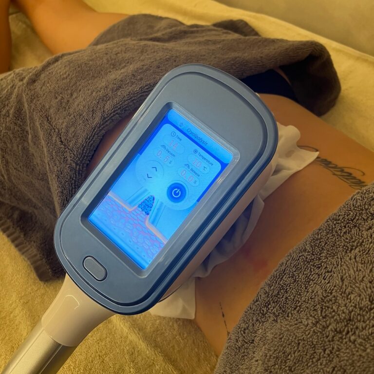 A cryolipolysis applicator is clamped to a client's abdomen during a body treatment.