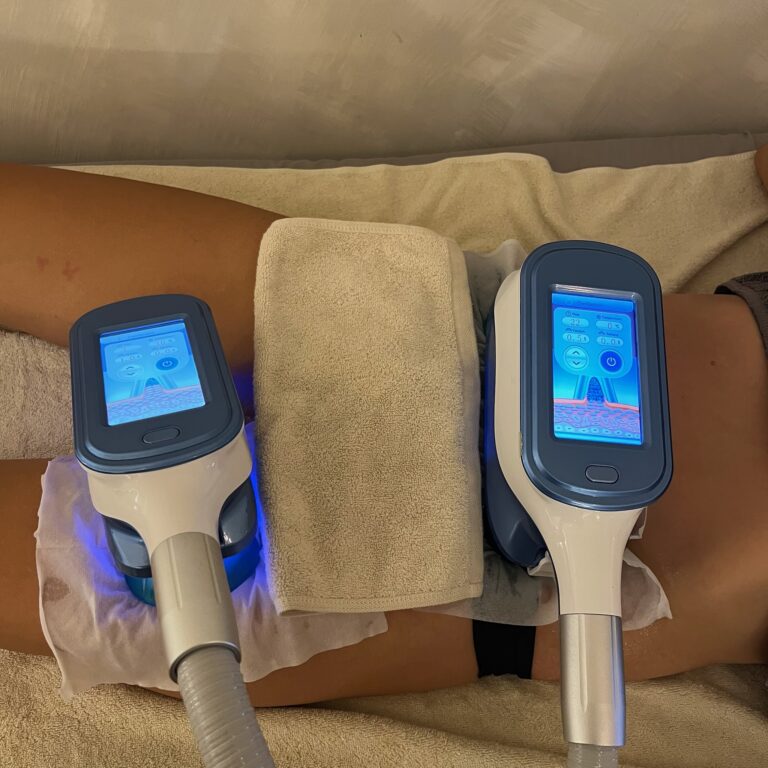 Two cryolipolysis applicators are clamped to a client's abdomen during a body treatment.