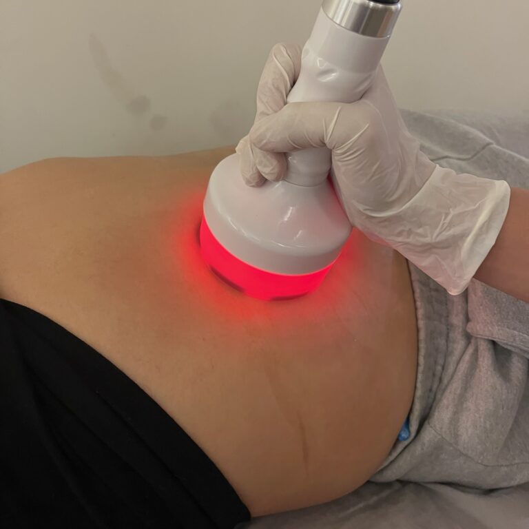 A therapist applies a radiofrequency handpiece to a client’s abdomen.
