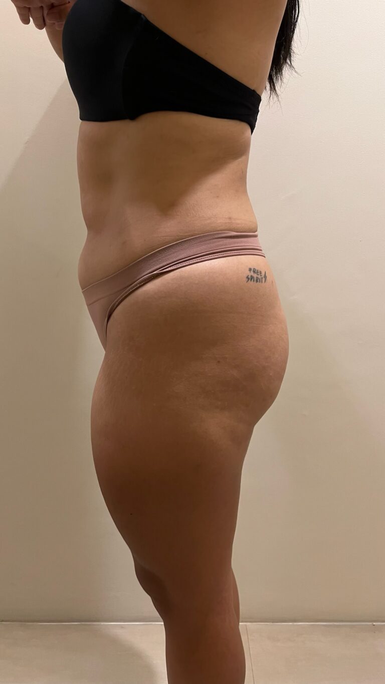 A side-profile view shows a client's abdomen, hip, and thigh in underwear.