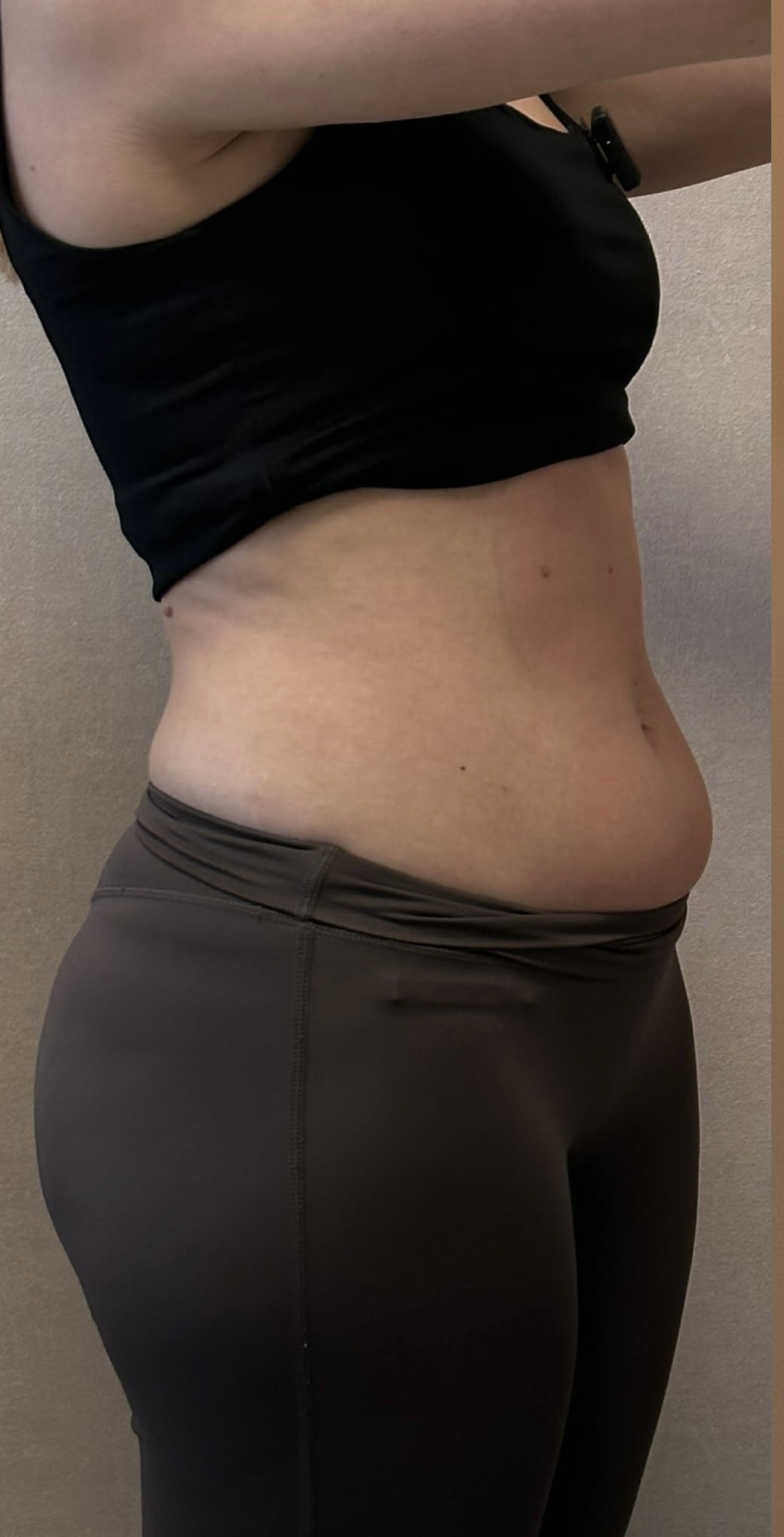 Before treatment result 4